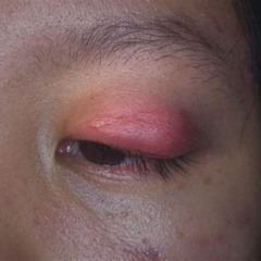 Best Treatment For Cellulitis Of The Eye Reviews