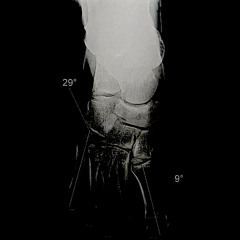 2nd DONUT (pEteR leUrs ChEviLLeS)