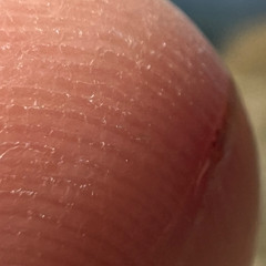 Finger cut