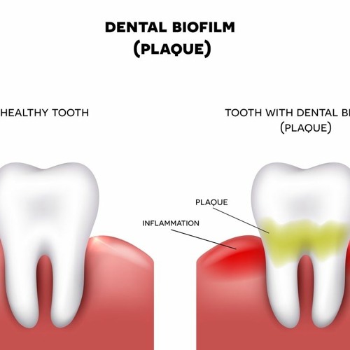 Stream What Does Plaque Buildup On Teeth Look Like [UPDATED] from