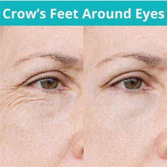 Best Treatment For Crows Feet Around Eyes Reviews