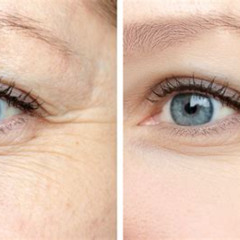 Best Fine Lines Under Eyes Treatment Reviews