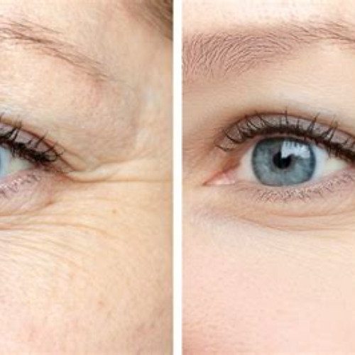 Best Fine Lines Under Eyes Treatment Reviews
