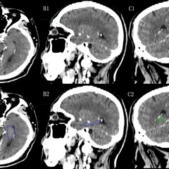 NEURON ACTIVE