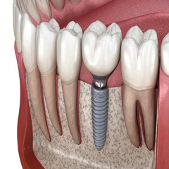 Dental Implants Care Tips for Long-Lasting Results