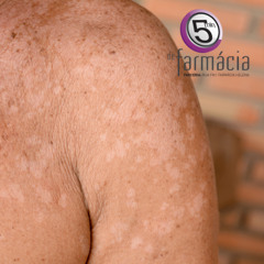 5 Minutos de Farmácia - 29Ago25 - Pitiríase versicolor - Alexandra Marcos