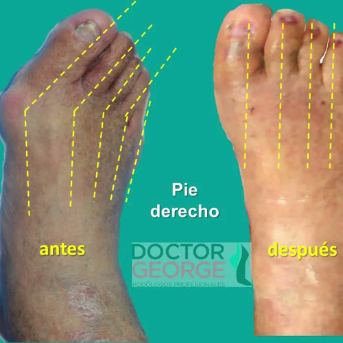 Stream episode 03nov2021/ PIE DIABÉTICO Causas, síntomas y