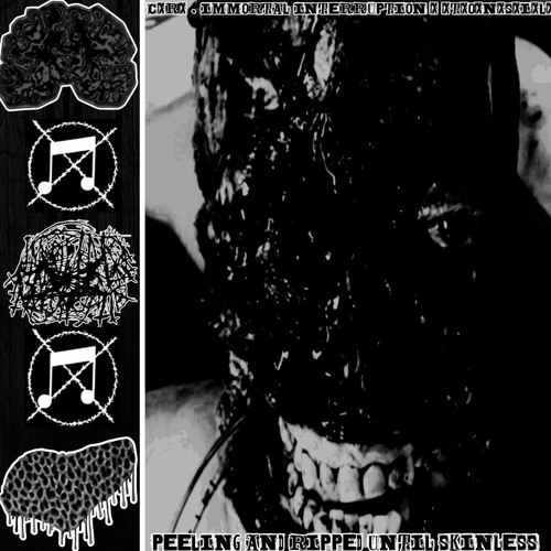 Burnt skin (Catalytic Radionecrosis)