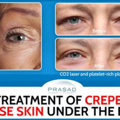 Best Treatment For Crepey Under Eyes Reviews