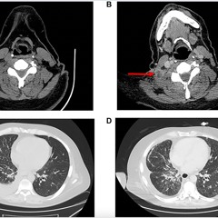 New Genetic Mutation Linked to Drug Resistance in Non-Small Cell Lung Cancer Patient