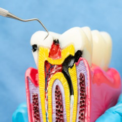 Step-by-Step Guide to Root Canal Treatment in Palm Desert