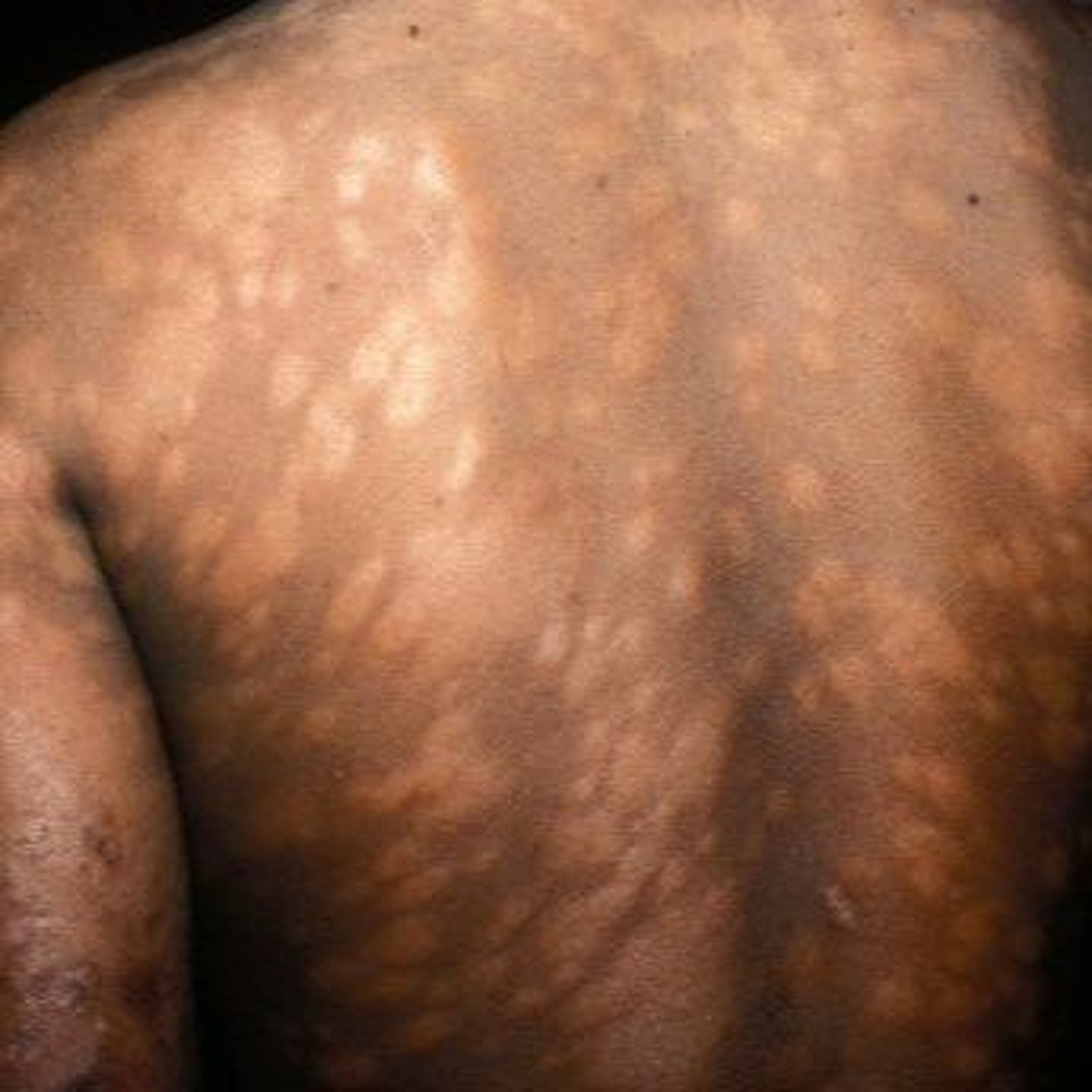 WELBODI Episode 200 Leprosy And Bipolar Disorder episode artwork