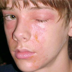 Best Poison Ivy Eye Treatment Reviews