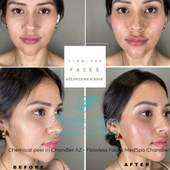 Chemical peel in Chandler AZ - Flawless Faces MedSpa Chandler