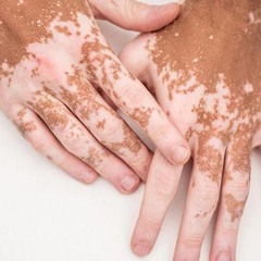 Types and Variations of Vitiligo