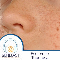 Genecast #039 - Esclerose Tuberosa