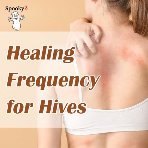 Healing Frequency for Hives - Spooky2 Rife Frequency Healing