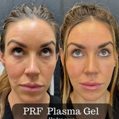 Best Prf Under Eyes How Many Treatments Reviews