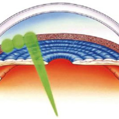 Best Laser Eye Treatment For Glaucoma Reviews