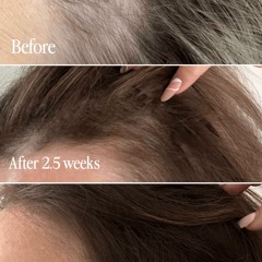 Reddit Nutrafol: How Nutrafol's Women's Hair Growth Supplement Helped Me Regrow ?