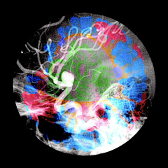 Coiled Aneurysm