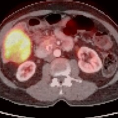 Immunotherapy Success in KRAS G12C Adenosquamous Pancreatic Cancer