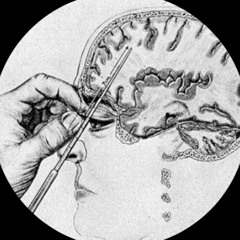 tRiStOkoNi - Transorbital Lobotomy