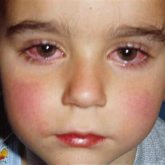 Best Treatment For Runny Nose And Watery Eyes Reviews