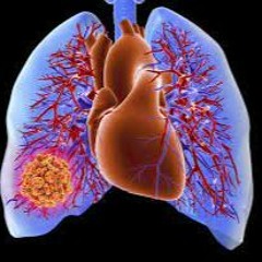 From Acute Pulmonary Embolism To Post - Pulmonary Embolism Sequelae