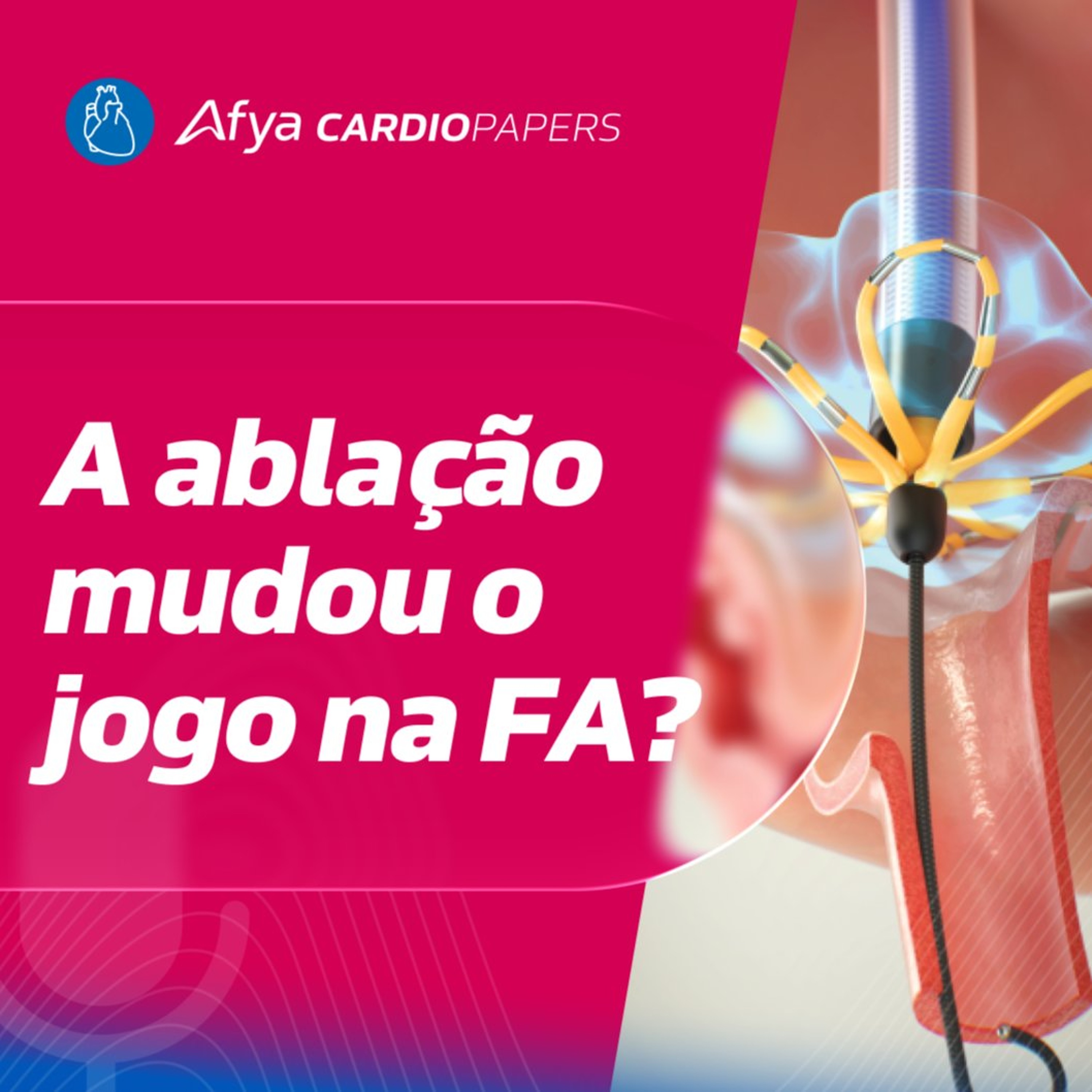 Aonde entra a ablação no tratamento da FA?