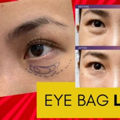 Best Laser Treatment To Remove Bags Under Eyes Reviews