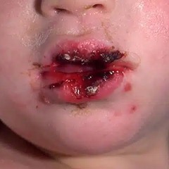 herpes