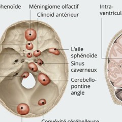 PAUSE SANTE - Méningiome (Lundi 20 Janvier 2025)