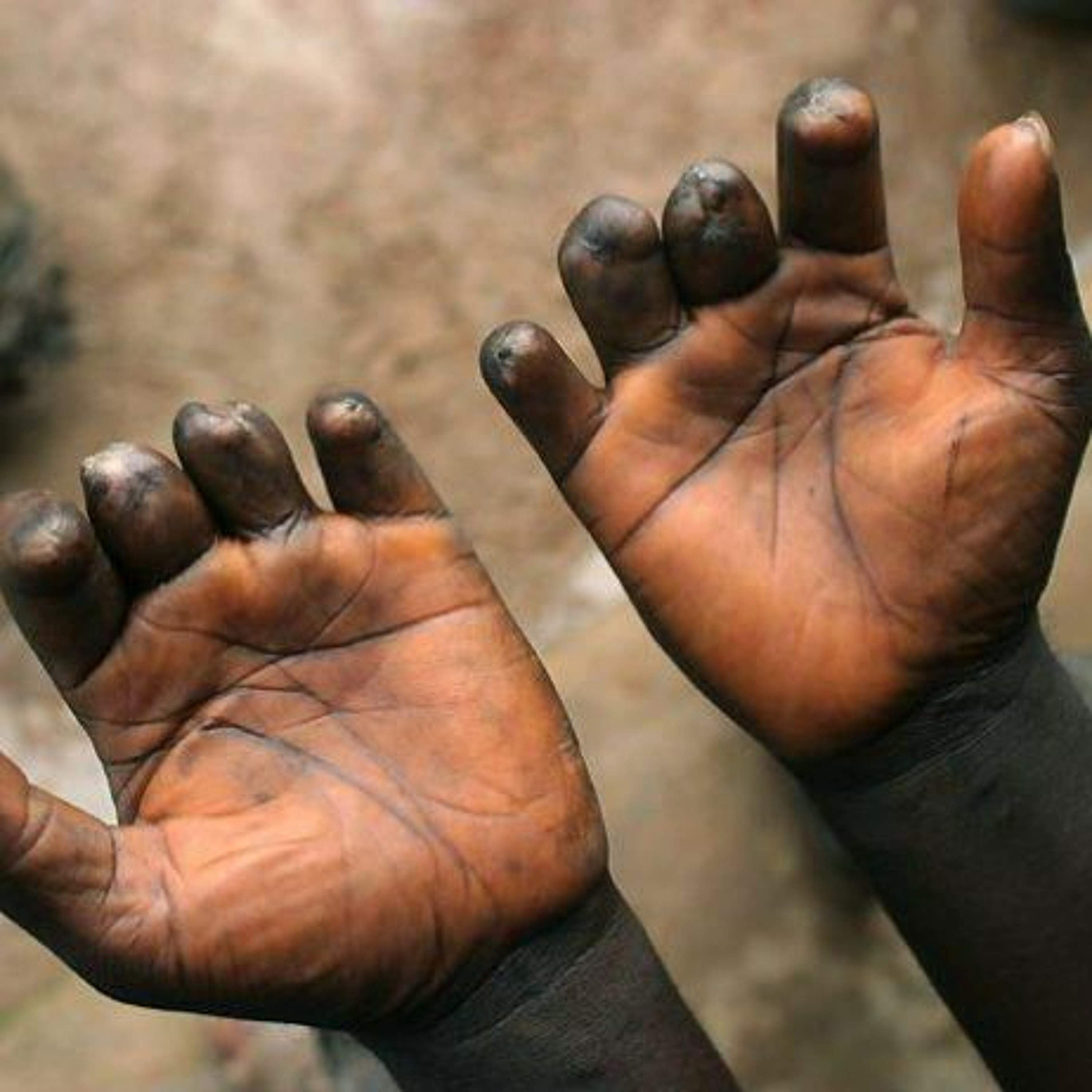 [Reportage Sénégal] : Vivre avec la lèpre, l’impossible guérison episode artwork