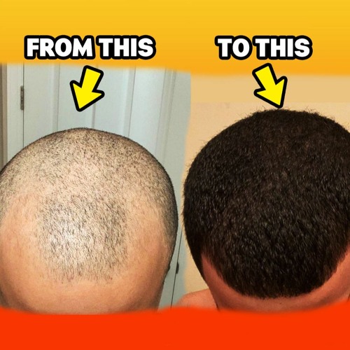 Stream The Big 3 Hair Loss Stack Hyper Responder Insane 3 5 Month Results By More Plates More Dates Listen Online For Free On Soundcloud