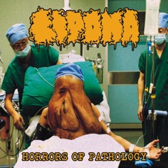 Lipoma-The Limits of Mortality
