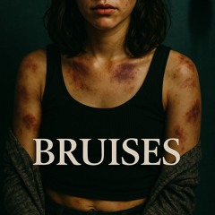 Bruises