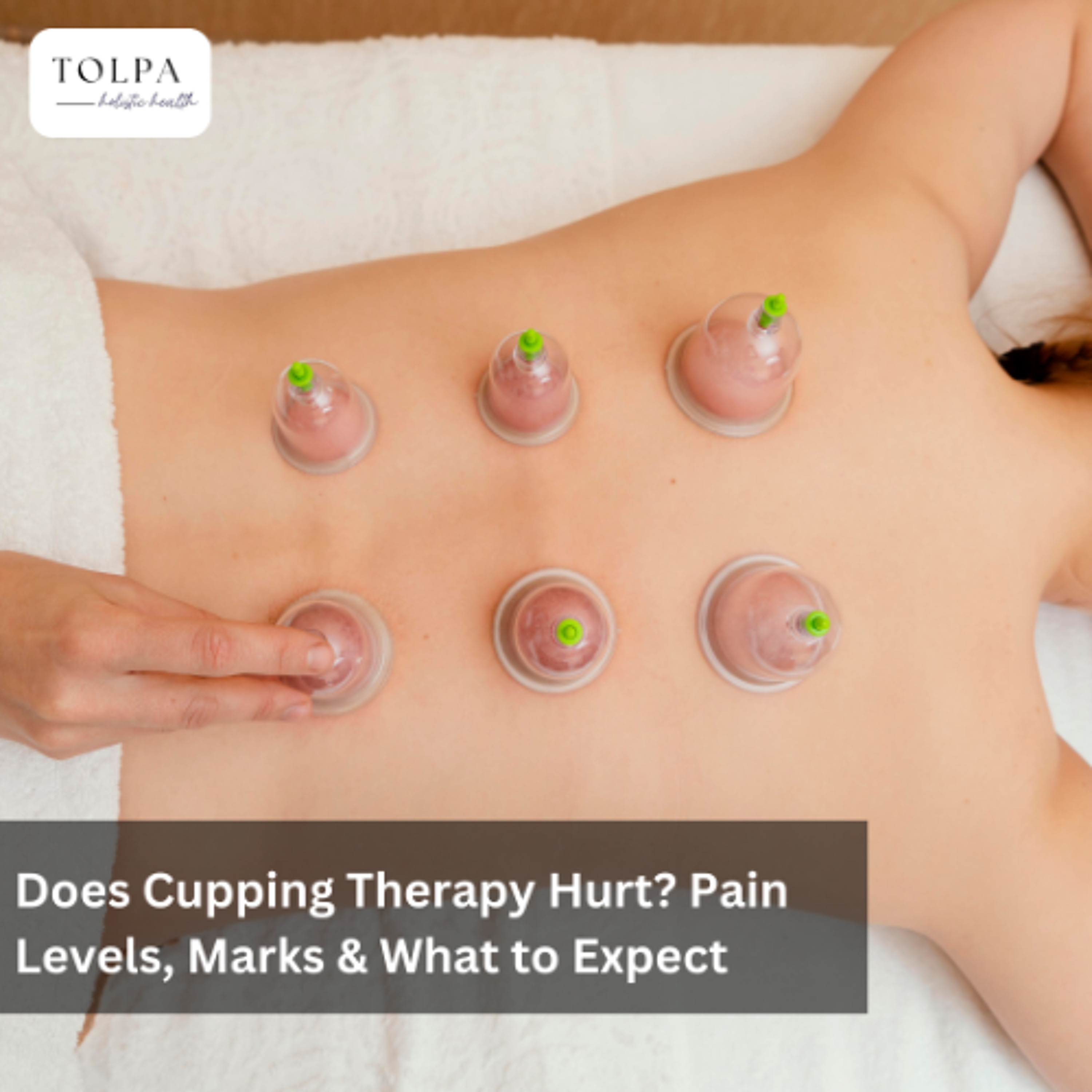 Does Cupping Therapy Hurt? Pain Levels, Marks & What to Expect