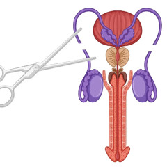 Narok, Man Opposes Convention, Chooses Vasectomy to Protect Family’s Future