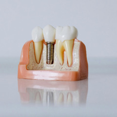 How to Choose the Right Surgeon for Dental Implants in Washington