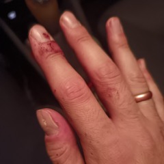 mi si bruciava la faccia, una fiamma non è una fiamma, ma un insieme di braccia