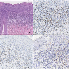 Early Immune Evasion Found in HPV-Related Pre-Cancer Lesions of the Anogenital Region