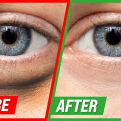 Best Treatment For Puffy Under Eyes And Dark Circles Reviews