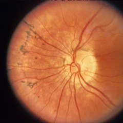 Retinitis Pigmentosa