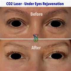 Best Co2 Under Eye Treatment Reviews