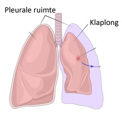 Klaplongen