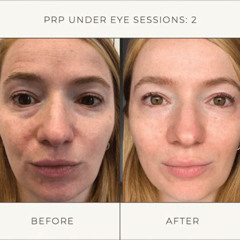 Best Under Eye Plasma Treatment Reviews