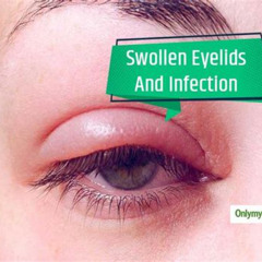 Best One Eye Swollen In The Morning Treatment Reviews