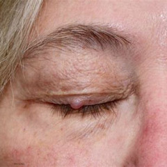 Best Bump Near Eye Corner Treatment Reviews