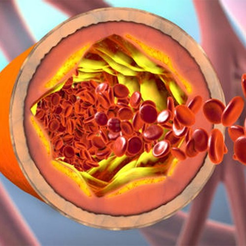 Eye Arteriosclerosis (CAFL)